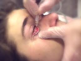 Image result for Eye Irrigation