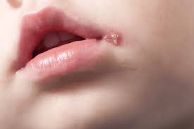 Infection with herpes simplex virus type 1 causes cold sores. Cold Sores Prevalence Causes Symptoms Remedies Precaution Factdr