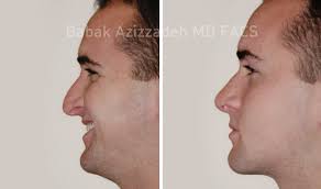 Your doctor uses endoscopy and specialized tools to remove bone that is constraining the eye muscles, optic nerve and fat in the space behind the eye. Male Rhinoplasty Beverly Hills Center