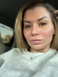 3 months post-op experience with MMO implants and chin lipo