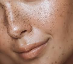 Image result for Melasma