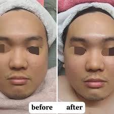 接单啦！ 一位长期驾grab 的司机认为自己的油性皮肤即使在车内也容易暴晒皮肤尤其是右边脸颊容易长斑面诊了他的皮肤状况