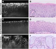 Scattering-Based Light-Sheet Microscopy Imaging of Human  Papillomavirus–Associated Squamous Lesions of the Anal Canal: A  Proof-of-Principle Study