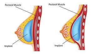 In fact, most upper body movements we do involve the pectoral muscles. Breast Implant Placement New Orleans La Northshore Plastic Surgery
