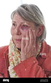 Trauma ocular hi-res stock photography and images