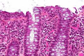 Image result for Microscopic Colitis