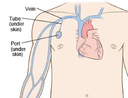 The port will be put under the skin. Vascular Access Port Implantation Saint Luke S Health System