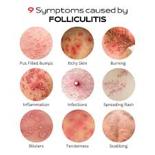 Image result for folliculitis symptoms