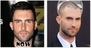 Truth Behind David Beckham S Hair Transplant Rumors Http Www Skncosmetics Com Celebrities Da Fue Hair Transplant Best Hair Transplant Hair Transplant Surgery