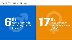 Cancer cells of this type look like the urothelial cells lining the inside of the bladder. Bladder Cancer