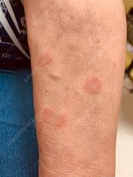 Image result for Vasculitis