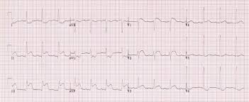 Ecg practice case study with interpretation by dr. Ecg Case 001 Litfl Ecg Top 100 Self Assessment Quiz