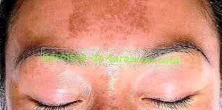 Tratament de lunga durata acasa.serul pentru pete maronii pigmentare pe piele white dr. Melasma Sau Cloasma Ce Este Tratamente Naturiste