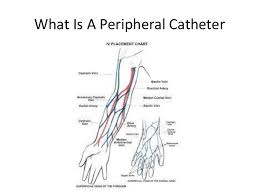 peripheral iv starts