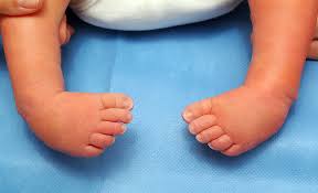 pes ekinovarus pev nedir nasil tedavi edilir anneysen