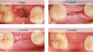Image result for Alveolitis sicca)