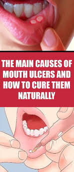 Biting The Inside Of Your Cheek Treatment Natural Treatment For Mouth Ulcers Mouth Ulcers Causes Of Mouth Ulcers Mouth Ulcer Treatment
