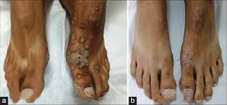 They can be agonizing owing to their presence on. Intralesional Measles Mumps And Rubella Vaccine For The Treatment Of Recalcitrant Warts A Case Series And Review Of Literature Journal Of Skin And Sexually Transmitted Diseases