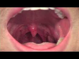 If left untreated, strep throat can cause rheumatic fever or inflammation of the kidneys. Sore Throat Vs Strep Diagnosing It At Home