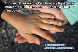 Eczema Le Remede De Grand Mere Efficace A Connaitre Eczema Comment Soigner L Eczema Remede Eczema
