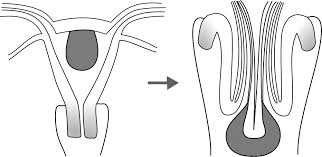 Image result for Uterine Inversion