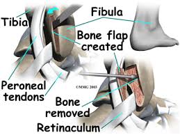 The supporting structures and layers on the medial side of the knee, an anatomic analysis. Physical Therapy In Erie For Peroneal Tendon Subluxation