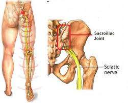 Learn about treatment and prognosis. Sacroiliac Joint Pain Can Cause Butttock Hip Or Back Pain