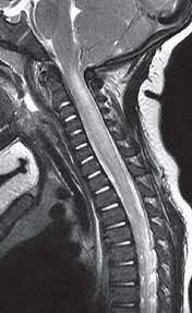 As part of a health sciences university, baylor medicine in houston, texas puts the latest treatments, innovations, and therapies in the hands of its highly trained doctors and care teams, who are working together to develop and deliver a care plan personalized for you. Acute Transverse Myelitis Radiology Key