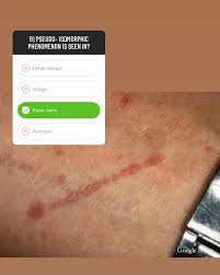 Image result for koebner phenomenon psoriasis