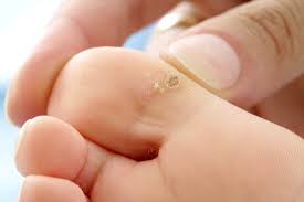 In multiple warts or recalcitrant warts most of the destructive methods are painful therefore it is materials and methods: Treatments For Common And Plantar Warts The Bmj
