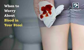 Image result for Blood in stool