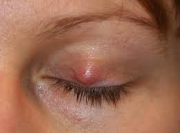 Wie es entsteht, wie du es hausmitteln am besten behandelst und wie du die entzündung im auge vermeidest. Gerstenkorn Hagelkorn Auge Online
