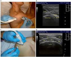 Image result for Shoulder Presentation