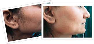 Fight the root cause with diet and exercise Faqs For Laser Hair Removal With The Soprano Ice Rosemary Fusca Blog