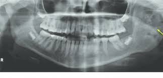 Treatment with minimally invasive surgery. Atypical Presentation Of Giant Mandibular Aneurysmal Bone Cyst With Cemento Ossifying Fibroma Mimicking Sarcoma Happidoc