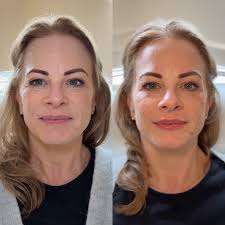 Real talk — collagen production naturally slows down from our mid-20s,  which is why collagen banking is such a game changer. Treatments like  microneedling help your skin build and preserve collagen, improving