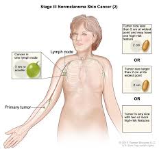 If cancer has spread to the axillary lymph nodes, a doctor may recommend extracting the lymph nodes during this procedure to remove the cancerous cells. Cancerhelp Online Nci Cancer Diagnosis And Treatment