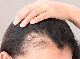 Envíos gratis a partir de 25€ más detalles. Lambdapil Anti Hair Loss Complete Solution For Alopecia Isdin