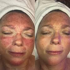 We are so excited to introduce our other licensed esthetician at TFP- Morgan  Pass 🥳🥂 Morgan is a graduate of Dalton Institute and is eager to provide  you with the skin of