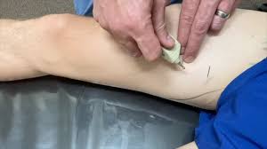 Image result for Obturator Nerve Compression