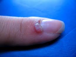 الثآليل الجلدية ما هي أسبابها و كيفية القضاء عليها و علاجها كبسولة