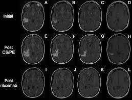 Demyelination is incorrectly often equated to multiple sclerosis, whereas in reality it is a generic pathological term simply describing, as the word suggests, the loss of normal myelin around axons in. Rituximab For Tumefactive Demyelination Refractory To Corticosteroids And Plasma Exchange Journal Of Neurology Neurosurgery Psychiatry