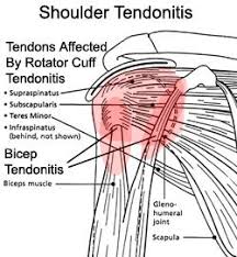Rotator Cuff Tendonitis And Rotator Cuff Tendonosis Rotator Cuff Tendonitis Rotator Cuff Bicep Tendonitis