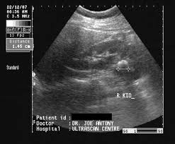 A Gallery Of High Resolution Ultrasound Color Doppler 3d Images Renal Calculi