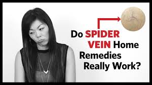 Eat foods rich in vitamin k (which improves blood clotting) and vitamin c (which strengthens blood vessels) to support better blood flow. Spider Vein Home Treatment Before And After Results Youtube