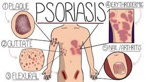 Image result for psoriasis