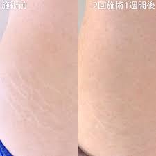 アートメイクSkin52｜妊娠線・肉割れ・ストレッチマーク・リスカ跡・傷跡修正｜費用やダウンタイムとは｜美容皮膚科・美容医療のTAクリニックグループ