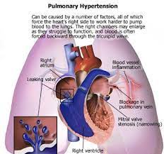 Sekundární plicní hypertenze vzniká nejčastěji na podkladě plicních chorob, které ztíží průtok krve plícemi (např. Sildenafil V Terapii Plicni Hypertenze Karolinas Net