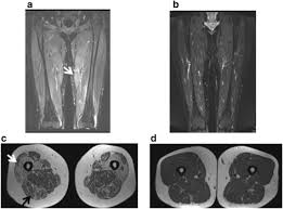 Muscles adapted for loaded versus unloaded actions. Comparative Analyses Of Muscle Mri And Muscular Function In Anti Synthetase Syndrome Patients And Matched Controls A Cross Sectional Study Arthritis Research Therapy Full Text