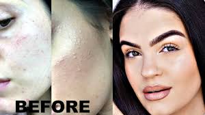 Keratosis pilaris hard bumps on face. How To Get Rid Of Textured Skin Keratosis Pilaris Acne Milia Youtube